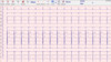 Mini PC ECG Device Ambulatory ECG Monitoring With Stable Software CE Approval